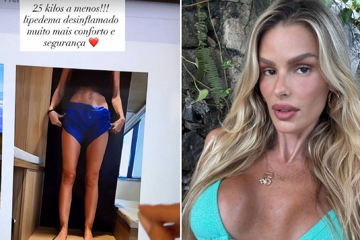 Yasmin Brunet revela ter perdido 25 kg em tratamento contra lipedema