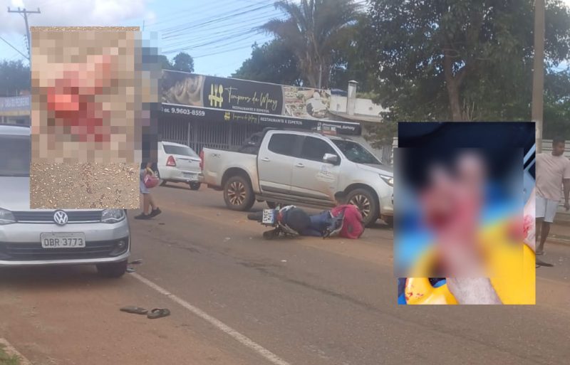 Motociclista tem dedos dilacerados e pé esfacelado após acidente entre motos em Rondonópolis; imagens fortes