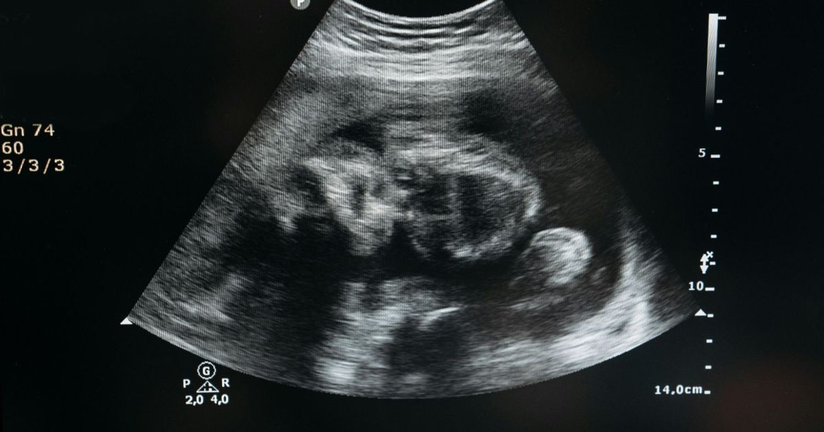 Justiça do RS cancela júri popular de mulher acusada de abortar em banheira